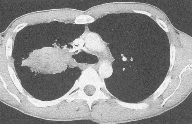 Tumorerkrankung der Lunge 