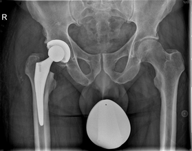 Röntgenaufnahme einer zementfreien Hüftprothese
