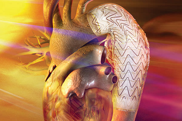 Stentgraft aufsteigende Thoraxaorta