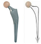 Links im Bild ein  zementfreier Hüftprothesenschaft, rechts im Bild ein zementierter Hüftprothesenschaft 