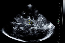 Ultraschall des Gehirns mit Darstellung der vergrößerten Substantia nigra bei M. Parkinson