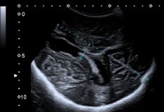 Ultraschall des Gehirns bei einem Patient nach großem Schlaganfall mit Entfernung des Schädelknochens und ausgeprägtem „Sinking-Skin-Flap-Syndrom“.